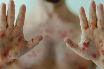 Paraná registra mais sete casos confirmados de Monkeypox