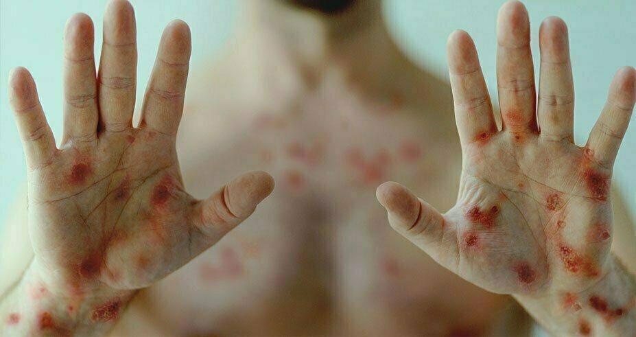 Paraná registra mais sete casos confirmados de Monkeypox