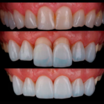 Lente de contato dental podem impulsionar a autoestima