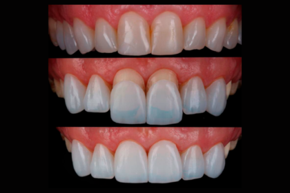 Lente de contato dental podem impulsionar a autoestima