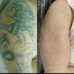 Brasil é segundo país em pesquisa sobre remoção de tatuagem