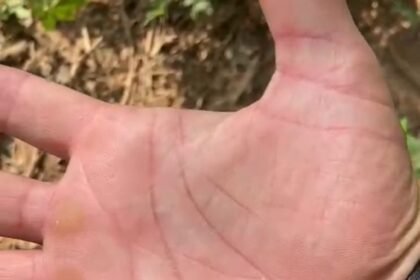 Vídeo de pescador com centenas de carrapatos viraliza