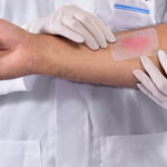 Por ano, 100 mil brasileiros são vítimas de acidentes envolvendo queimaduras