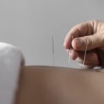 Acupuntura: SUS atende 1 milhão de pessoas anualmente