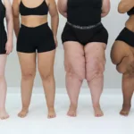 Lipedema