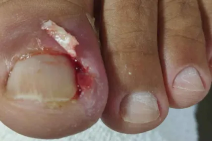 Como Evitar que a Sua Unha Fique Encravada