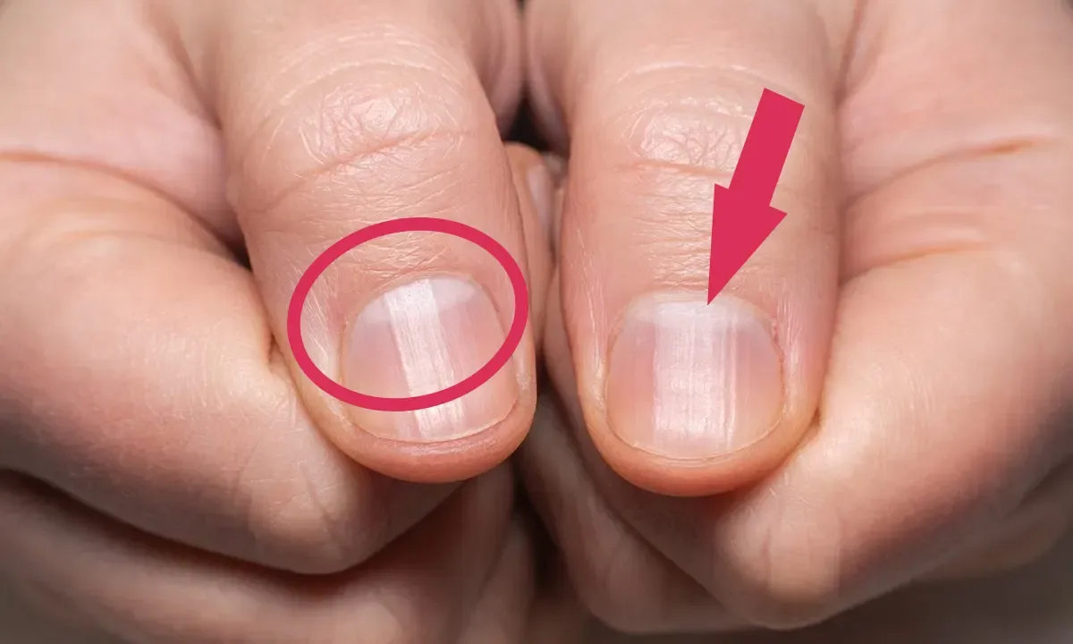 Lúnulas “Meia-lua da unha”